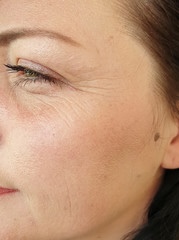 Photo avant traitement Fatou S. (DUPL)