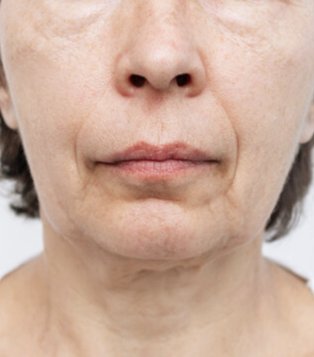 Photo avant traitement Fatou S. (DUPL)