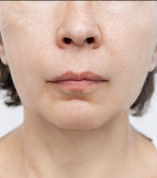 Photo après traitement Fatou S. (DUPL)