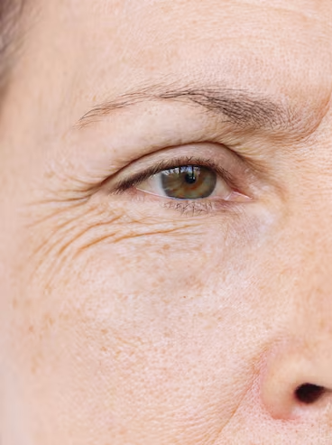 Photo avant traitement Fatou S. (DUPL)